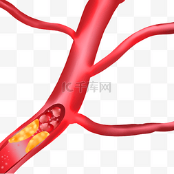 高血压眩晕图片_血栓血管血液