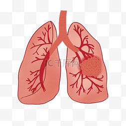 肺部肺炎肺癌