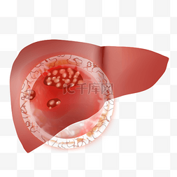 人体内脏肝脏肝癌