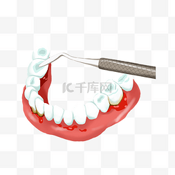 牙周炎治疗牙病