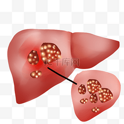 肝癌癌细泡