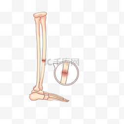 人体骨骼骨头骨折