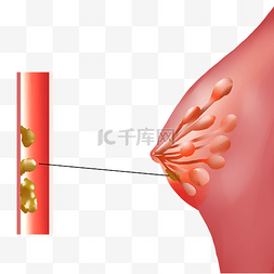 乳腺恶性肿瘤细胞