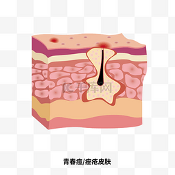 皮肤切口图片_青春痘皮肤状态问题立体剖面图