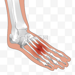 人体骨头图片_人体脚掌骨折