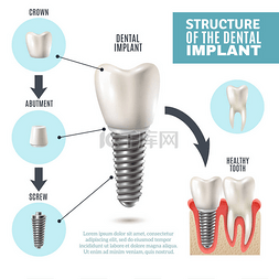 牙种植体结构医疗信息图表海报 