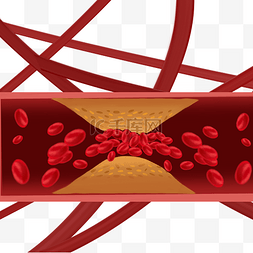 细胞血管图片_心血管细胞堵塞