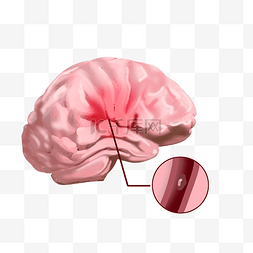 脑卒中卡通图片_脑疾病脑中风