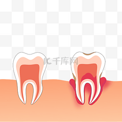 四颗牙齿图片_牙齿发炎牙周炎