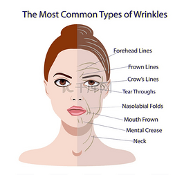 常见的面部皱纹类型。整容手术妇