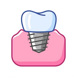 医学的图片_种植牙的插图。
