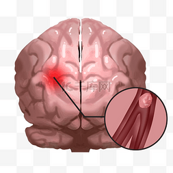 脑卒中符号图片_脑病脑中风