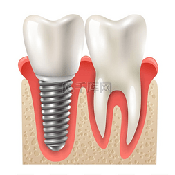 牙种植体牙齿设置特写模型牙科植
