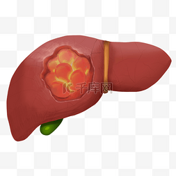 盆腔器官脱垂图片_脂肪肝肝硬化人体器官内脏医疗健