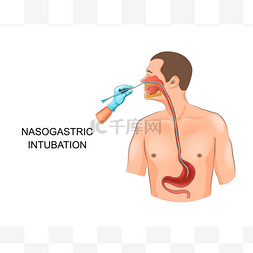 胃卡通图片_鼻胃插管的载体例证。在胃管