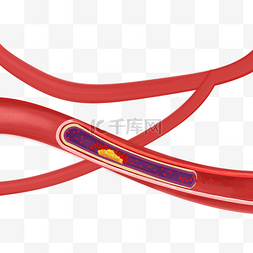 巨噬细胞黏附血管图片_人体动脉硬化心血管堵塞
