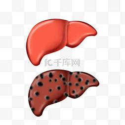 肝癌图片_脂肪肝肝硬化肝癌医疗器官肝脏内