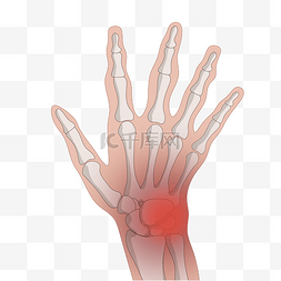 人体骨头图片_人体手部关节炎