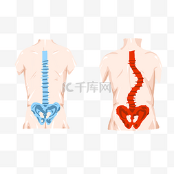 腰椎负重图片_脊柱侧弯矫正健身