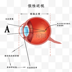 假性近视近视眼