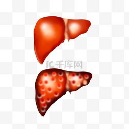 肝癌图片_肝脏脏器肝硬化医疗器官肝脏内脏
