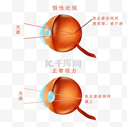 假性近视