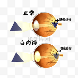 图像清晰模糊白内障眼睛