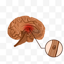 脑卒中符号图片_脑疾病脑中风