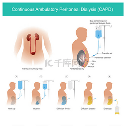 毛细血管图片_这是技术上使用腹膜腔输送透析液