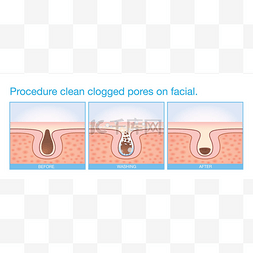 程序清洁堵塞毛孔脸部.