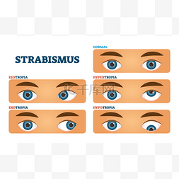 斜视图片_斜视或交叉眼视觉状况，矢量图解