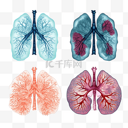 一组感染性肺炎的肺部图形表示