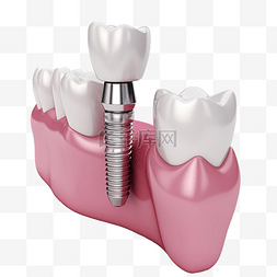 3d 牙龈与牙种植体隔离 3d 渲染插