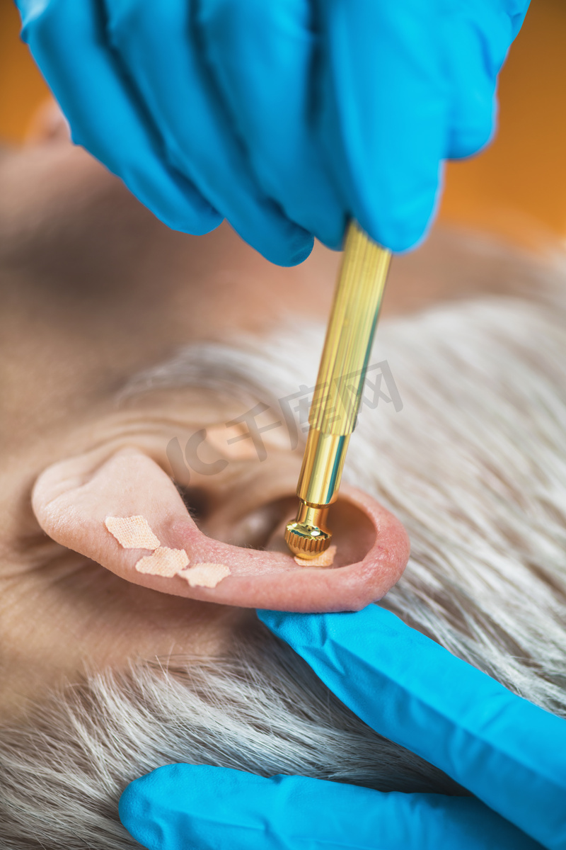 耳部治疗，或对人耳的眼膜治疗，特写。治疗师手应用针灸耳籽贴纸与钳子.图片