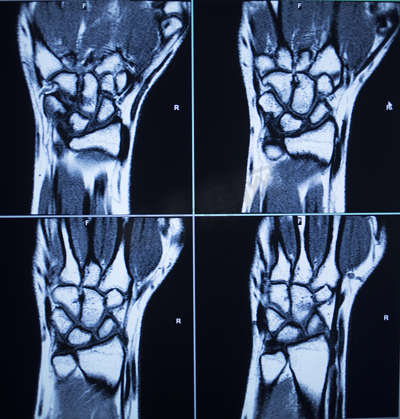 MRI 扫描测试结果手腕手部受伤图片