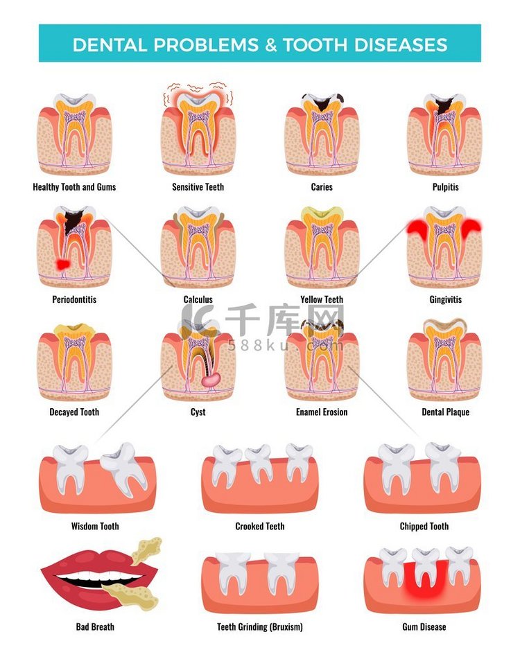 牙科口腔问题教育信息图表集与龋