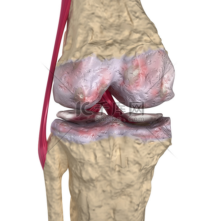 骨关节炎: 膝关节韧带和软骨
