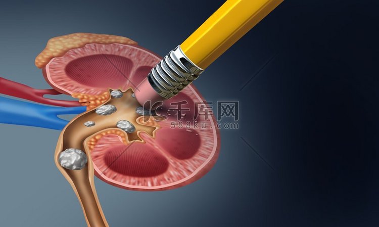  移除，肾脏，肾脏，结石