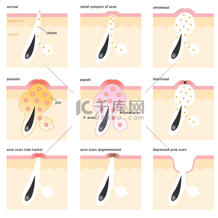 acne formation process