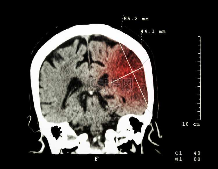 左半球脑梗塞（缺血性中风）（大