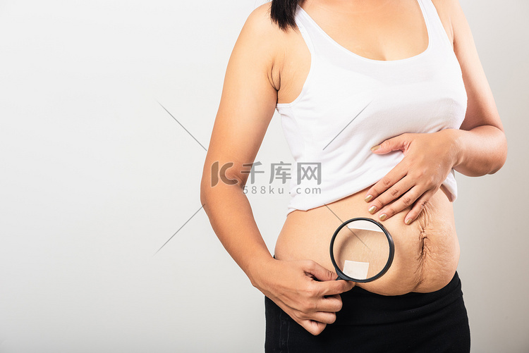 妇女使用放大镜显示妊娠纹下腹部