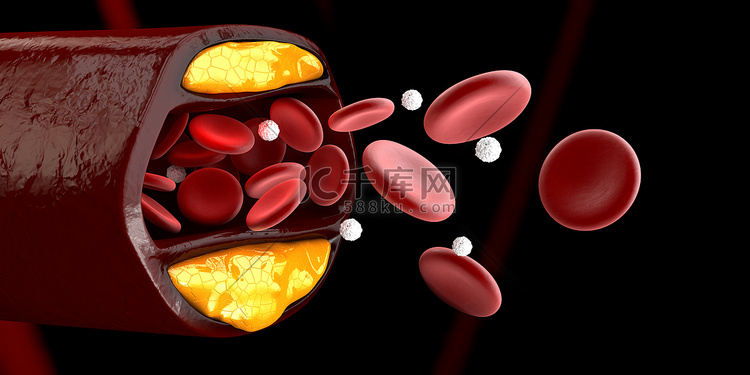 血细胞与胆固醇分离黑色斑块积聚