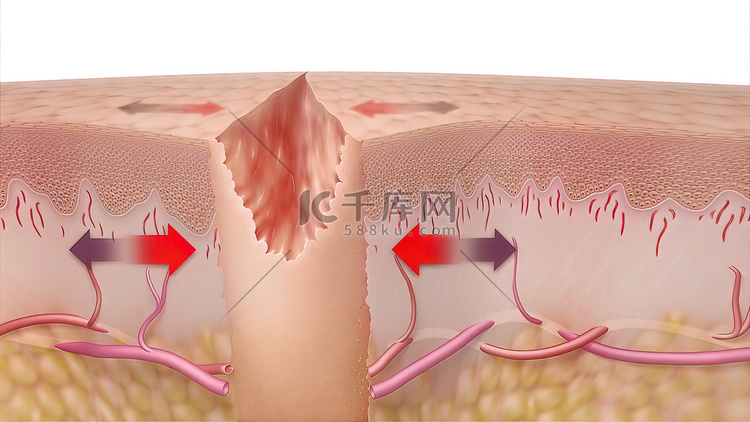 皮肤伤口愈合时间的 3D 医学插图