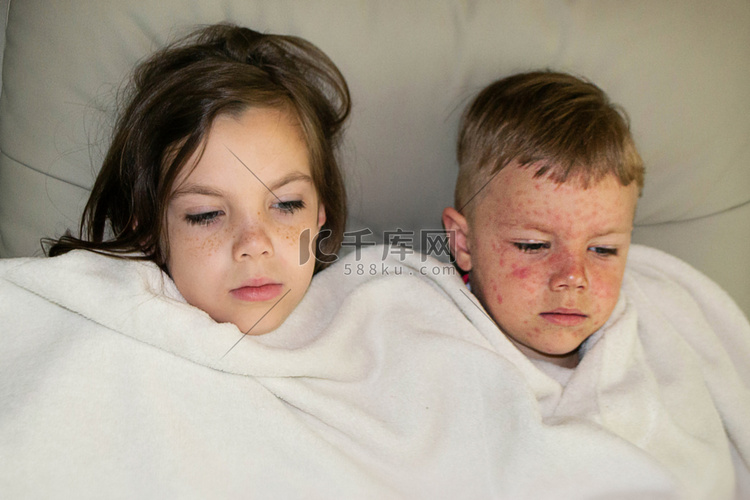 儿童水痘病毒或水痘泡疹