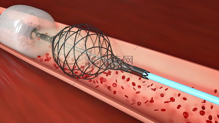 血管闭塞是血管的堵塞，通常伴有