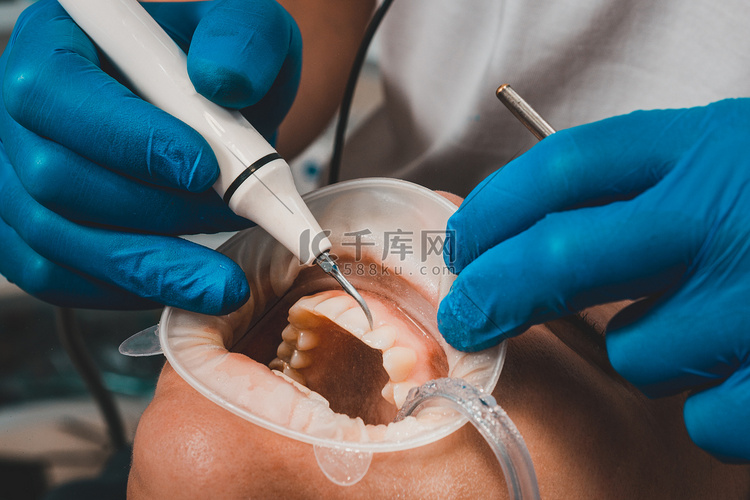 牙医使用超声波清除牙垢，牙医处