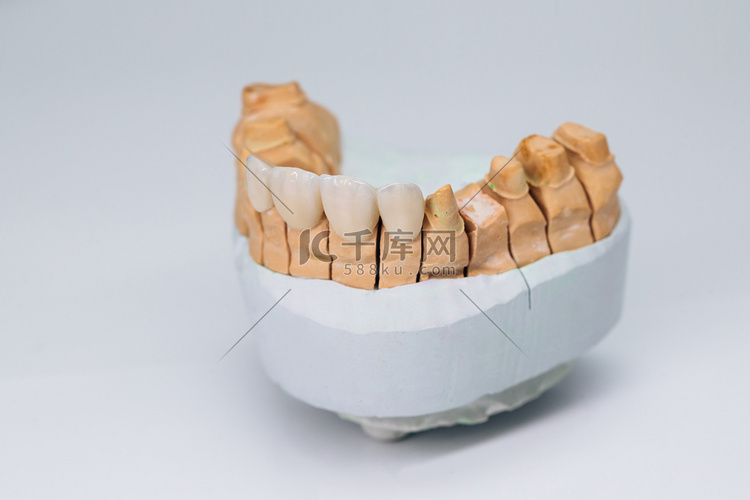 模型一颌骨上的牙科锆石陶瓷冠。