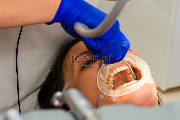 清除牙齿上的牙垢后，牙医仅使用