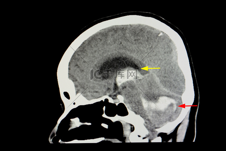 中风患者的 CT 脑部扫描