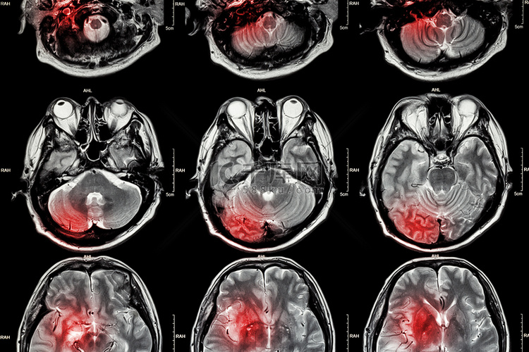 脑部 MRI（磁共振成像）胶片